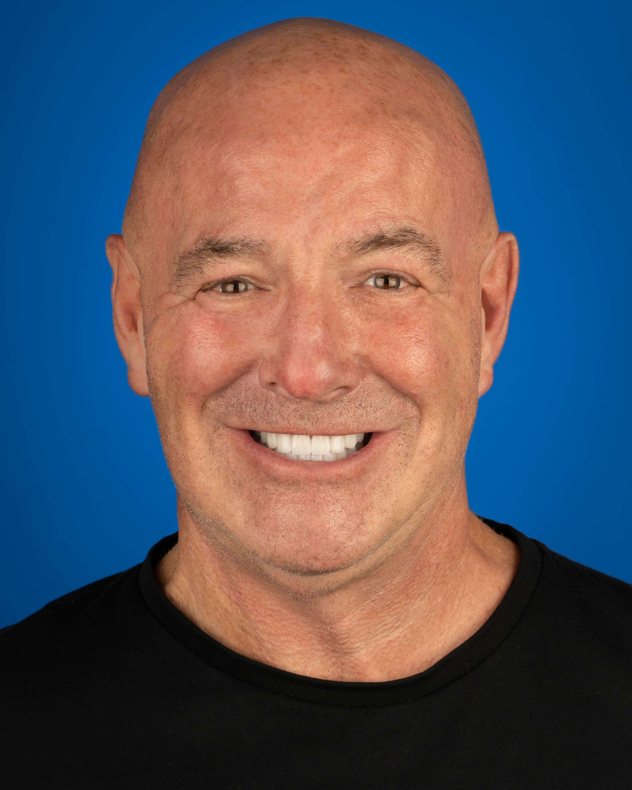 UK - Smile Design, 24x Zirconia Crowns