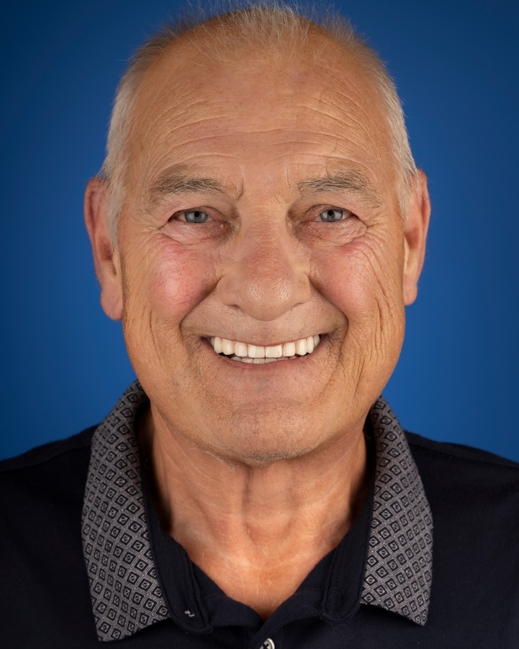 UK - Smile Design, 24x Zirconia Crowns