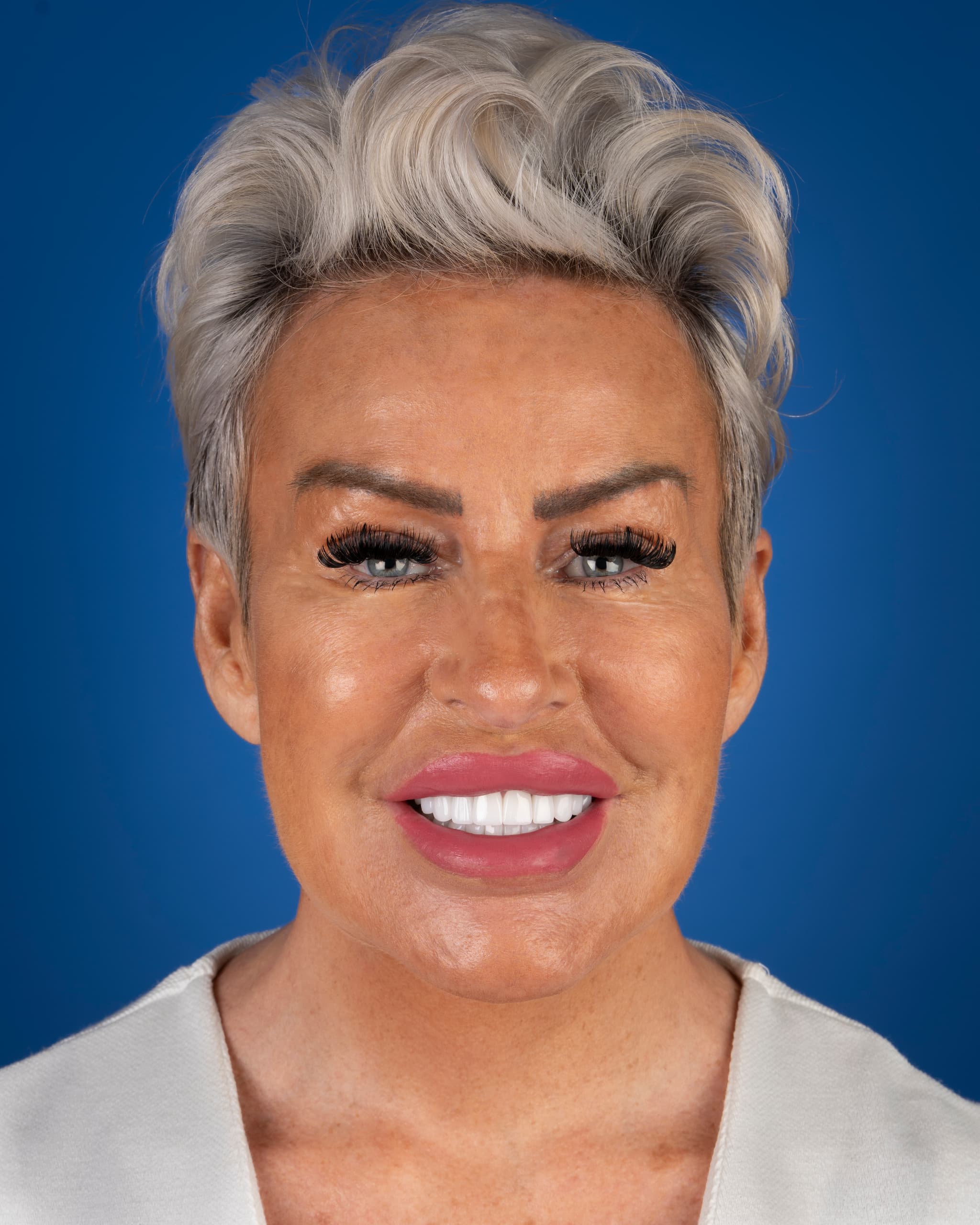 Poland - Smile Design, 27x Zirconia Crowns