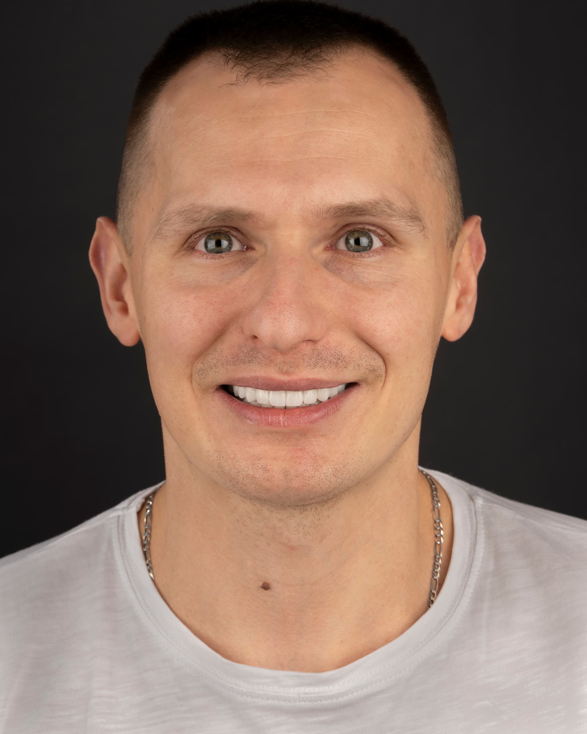 Poland - Smile Design, 25x Zirconia Crowns