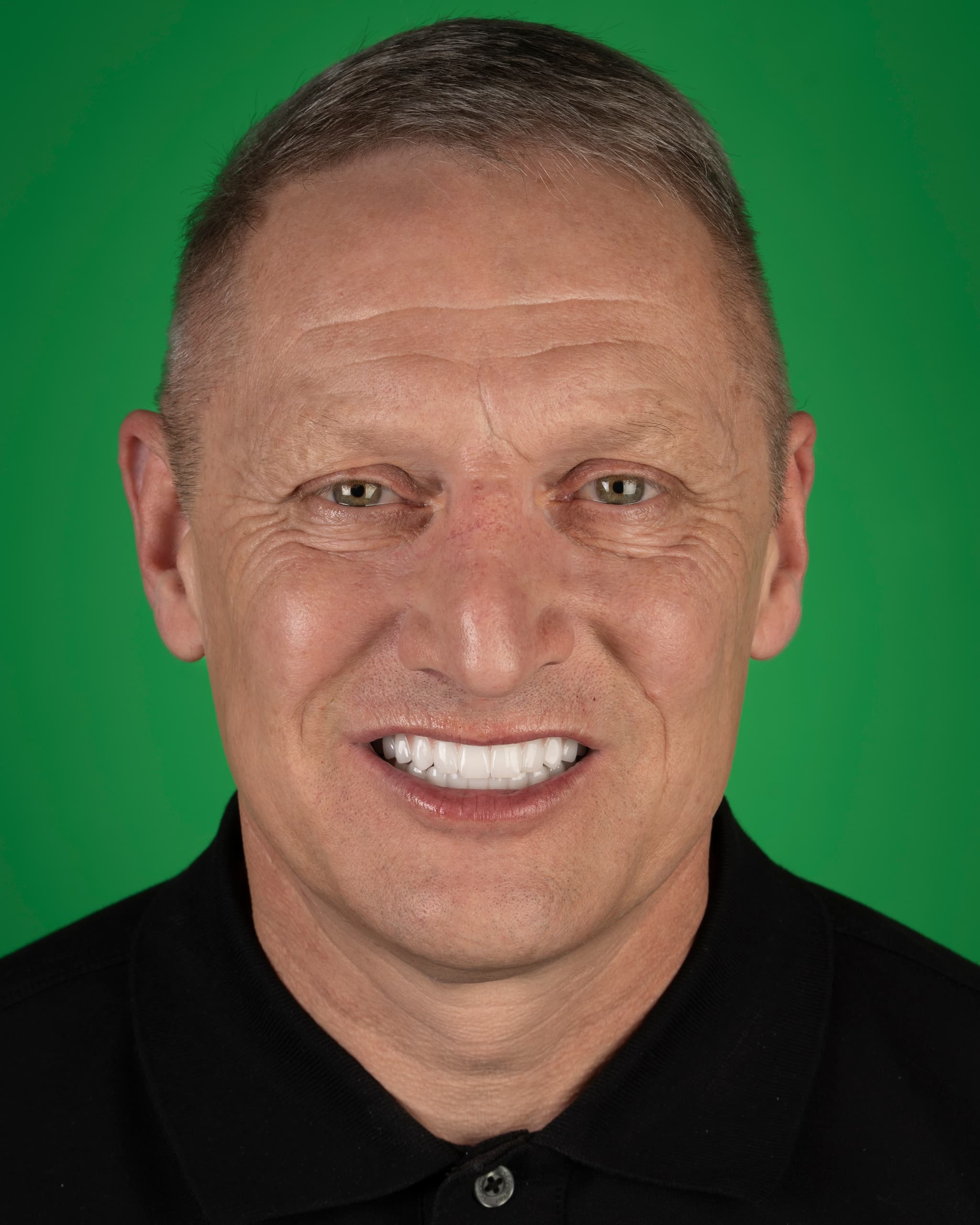 UK - Smile Design, 24x Zirconia Crowns